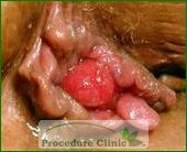 hemorrhoids
